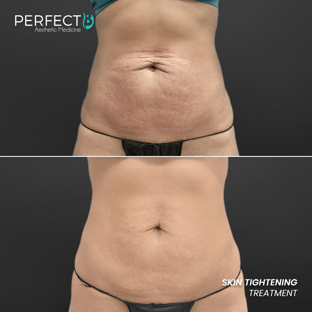 Perfect B - Results Image - [Skin Tightening] 4000 - 1080 x 1080