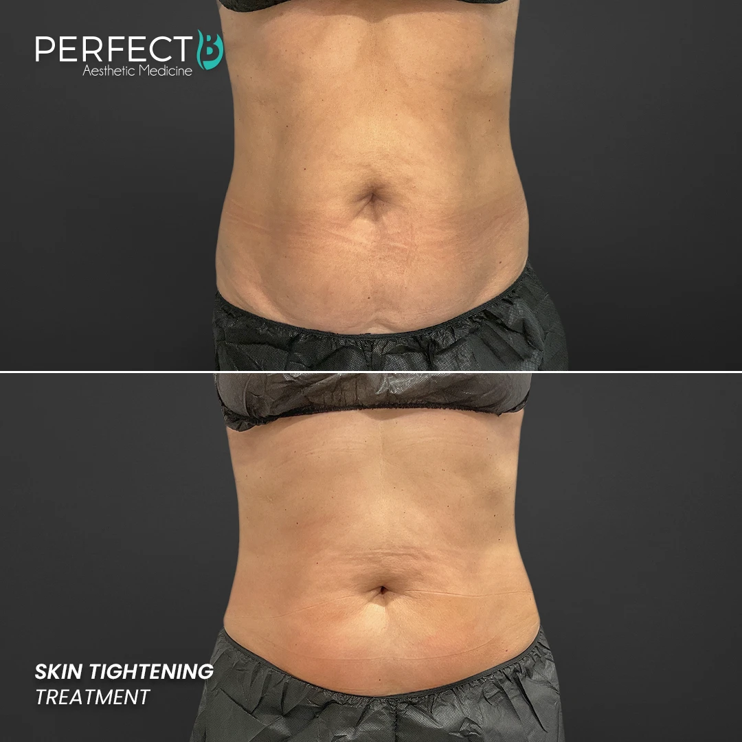 Perfect B - Results Image - [Skin Tightening] 4001 - 1080 x 1080