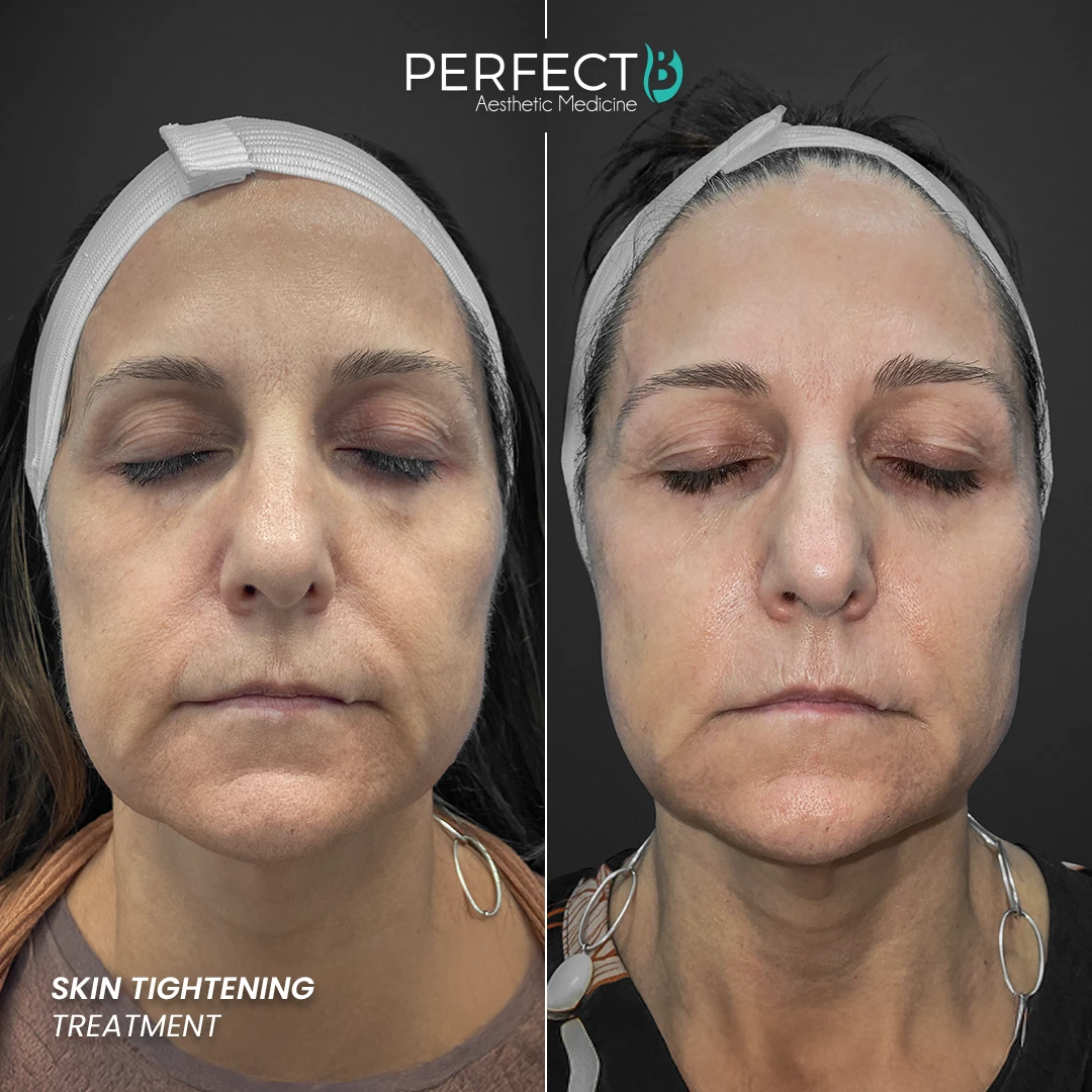 Perfect B - Results Image - [Skin Tightening] 4002 - 1080 x 1080