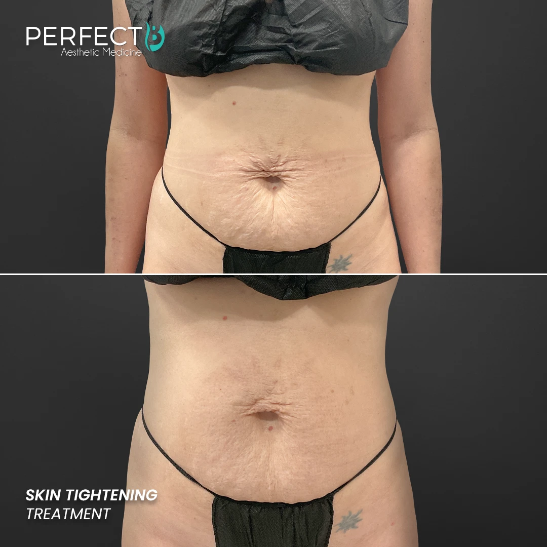 Perfect B - Results Image - [Skin Tightening] Case 4005 - 1080 x 1080