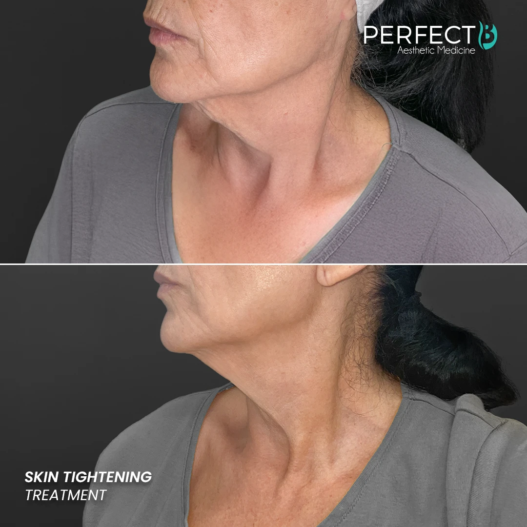 Perfect B - Results Image - [Skin Tightening] 4007 - 1080 x 1080