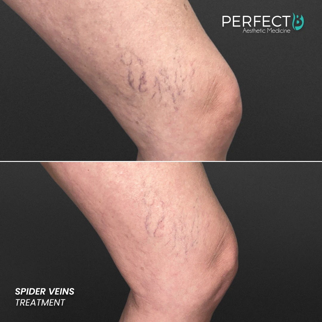 Perfect B - Results Image - [Spider Veins] 4000 - 1080 x 1080