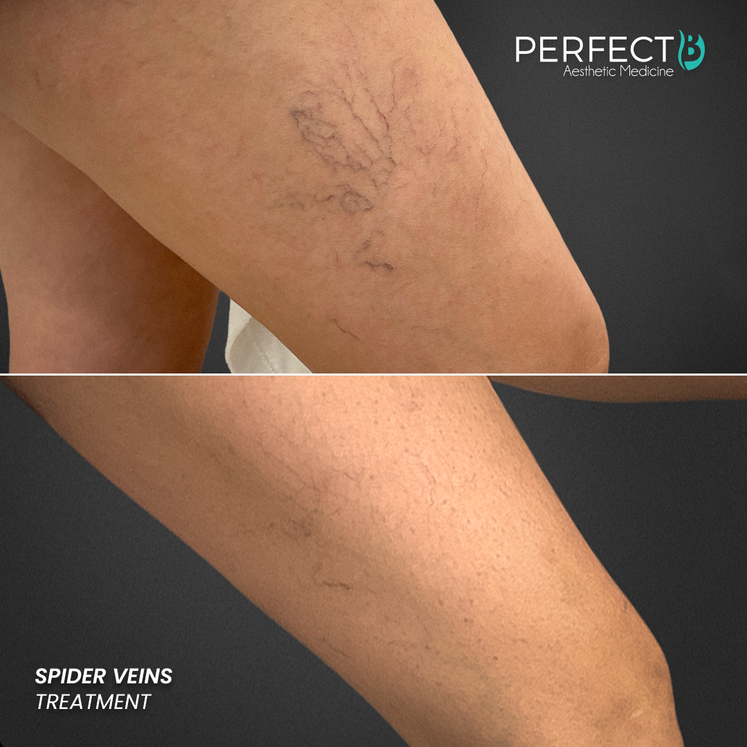 Perfect B - Results Image - [Spider Veins] 4001 - 1080 x 1080