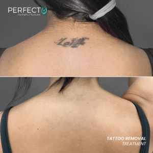 Perfect B - Results Image - [Tattoo Removal] 4000 - 1080 x 1080