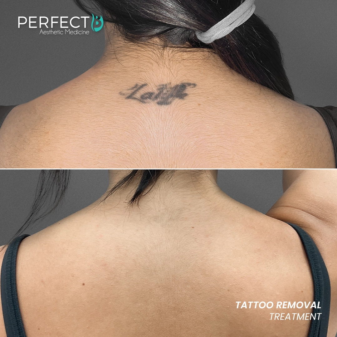 Perfect B - Results Image - [Tattoo Removal] 4000 - 1080 x 1080