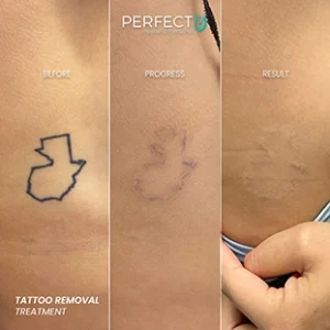 Perfect B - Results Image - [Tattoo Removal] 4002 - 1080 x 1080