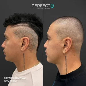 Perfect B - Results Image - [Tattoo Removal] 4003 - 1080 x 1080