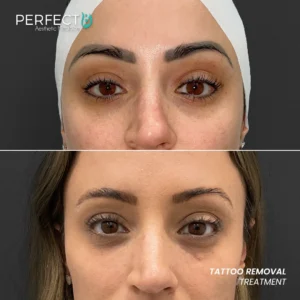 Perfect B - Results Image - [Tattoo Removal] 4004 - 1080 x 1080