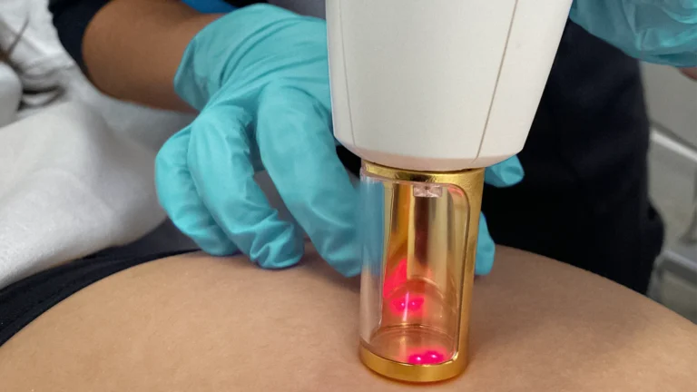 Perfect-B-Stretch-Mark-Reduction-treatment-Featured-Image