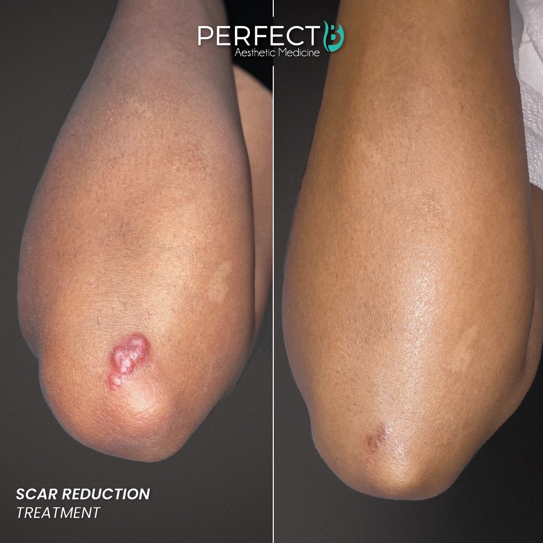 Scar Reduction Treatment - Perfect B - Results Image - Case 8913 - 1080 x 1080