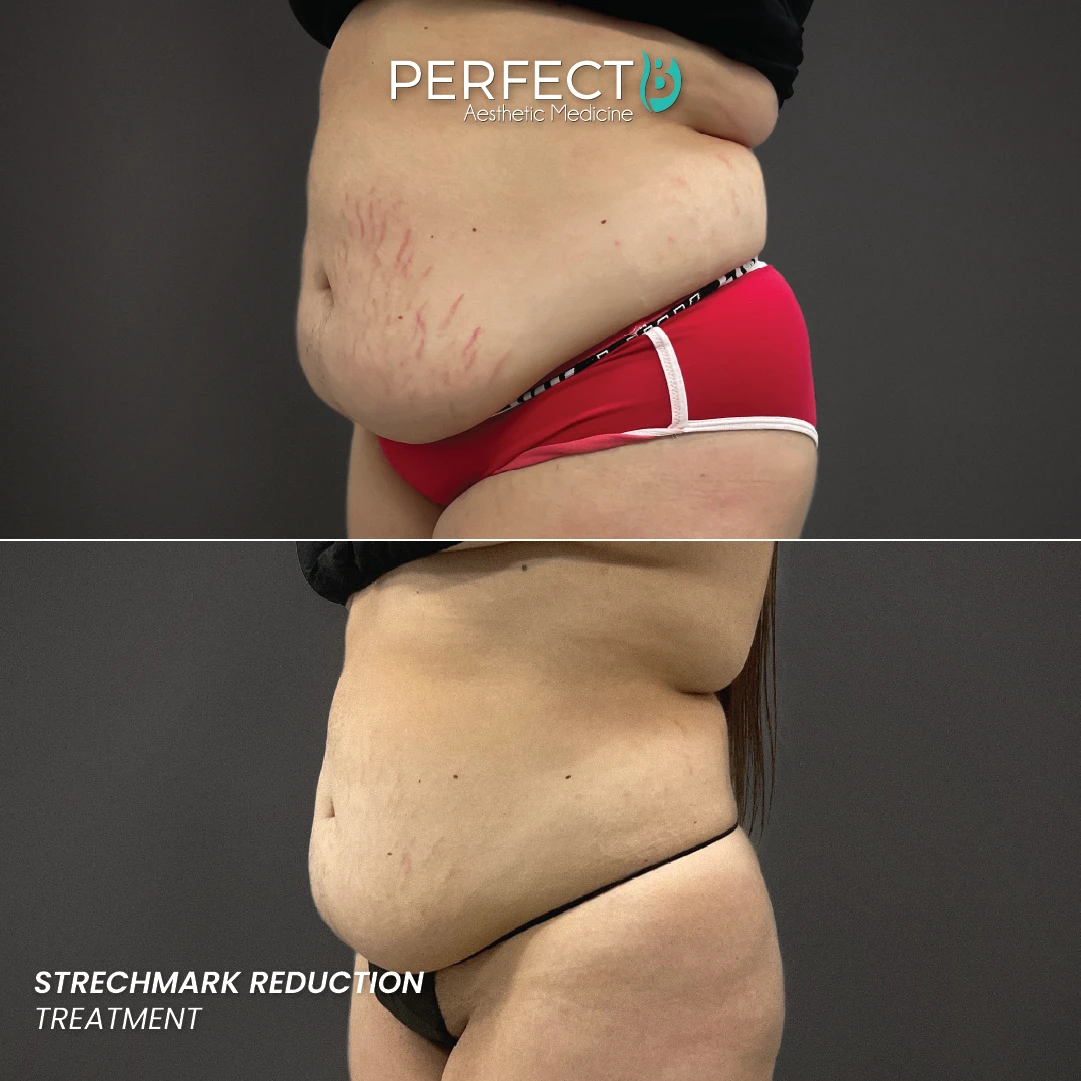 Strechmark Reduction Treatment - Perfect B - Results Image - Case B 9410 - 1080 x 1080