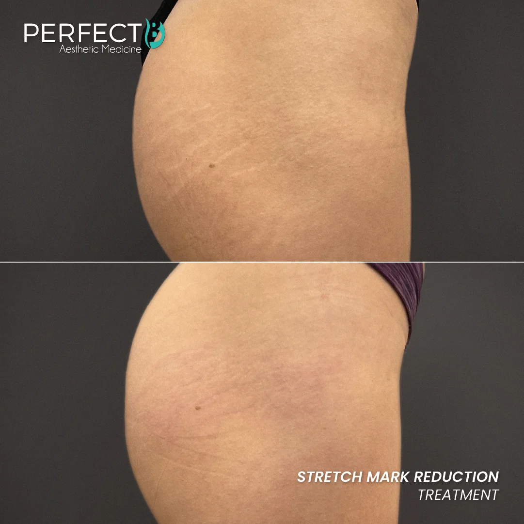 Stretch Mark Reduction Treatment - Perfect B - Results Image - Case 9403 - 1080 x 1080
