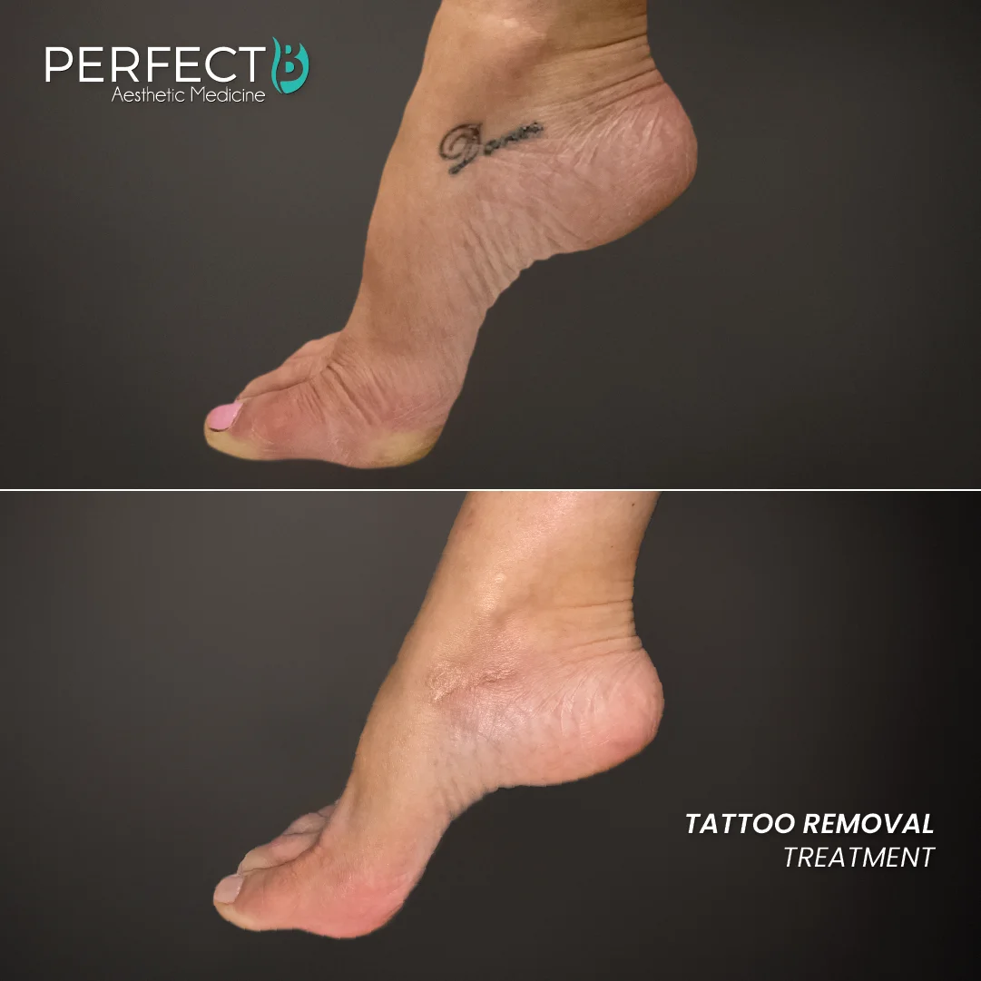 Tattoo Removal Treatment - Perfect B - Results Image - Case 9502 JH - 1080 x 1080