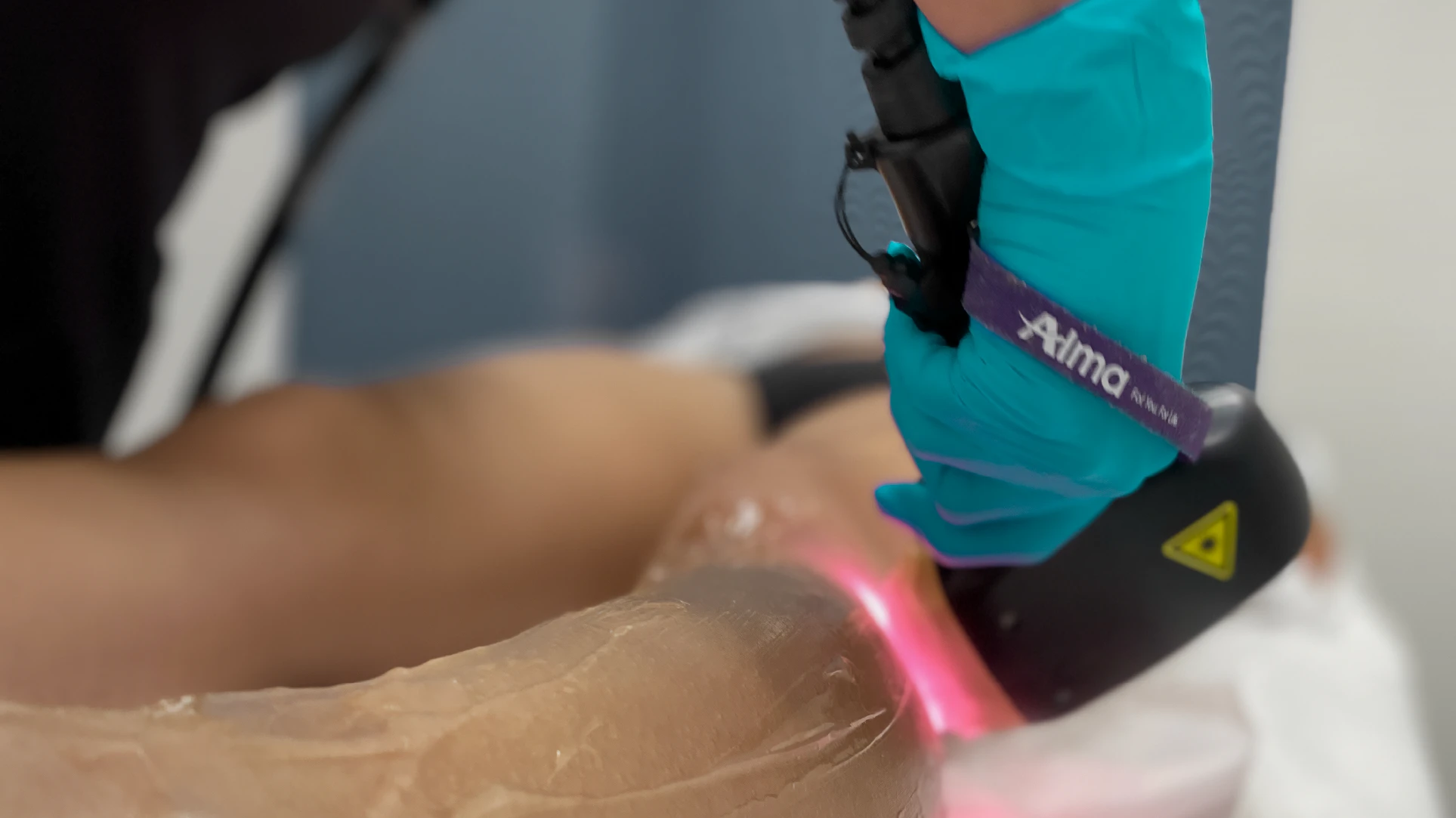 Yag 1064nm Laser - Perfect B - Featured Image