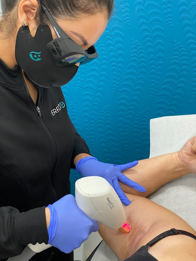 Laser Skin Rejuventation with ResurFx