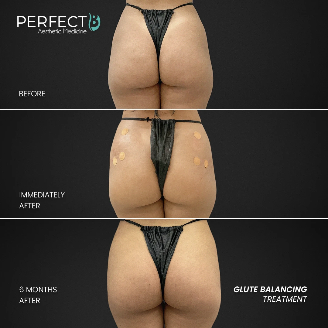 Perfect B - Results Image - [Glute Balancing] Case 4000 - 1080 x 1080