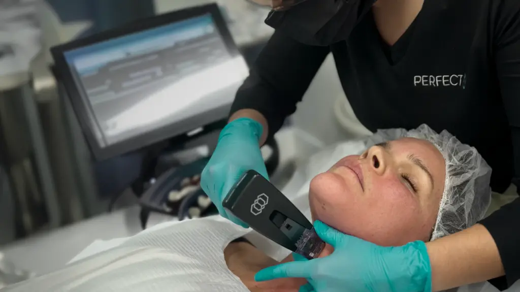 morpheous8, RF microneedeling