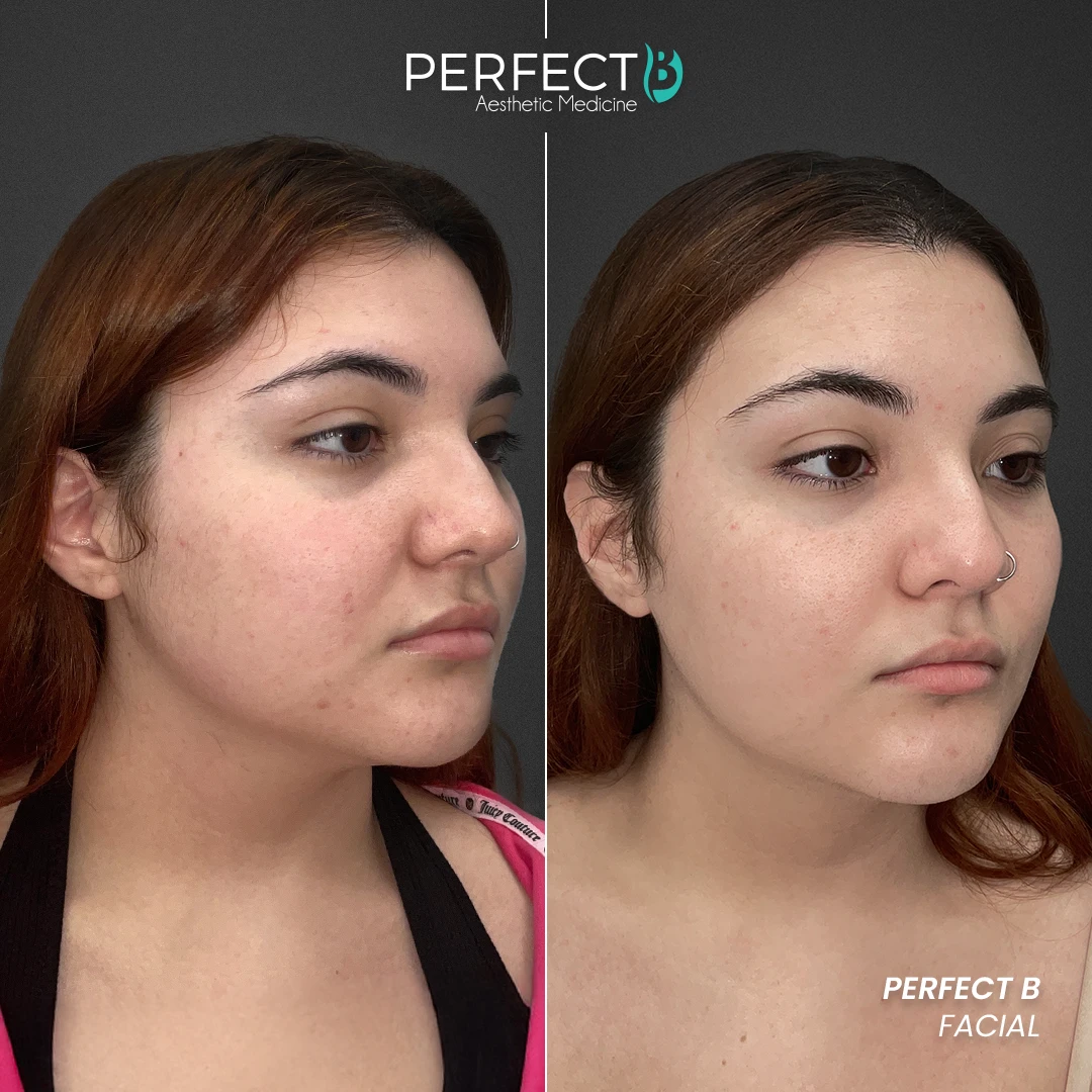 Perfect B - Results Image - [Perfect B Facial] 4001 - 1080 x 1080