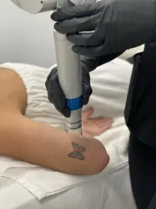 Perfect-B-Tattoo-Removal-Blog image