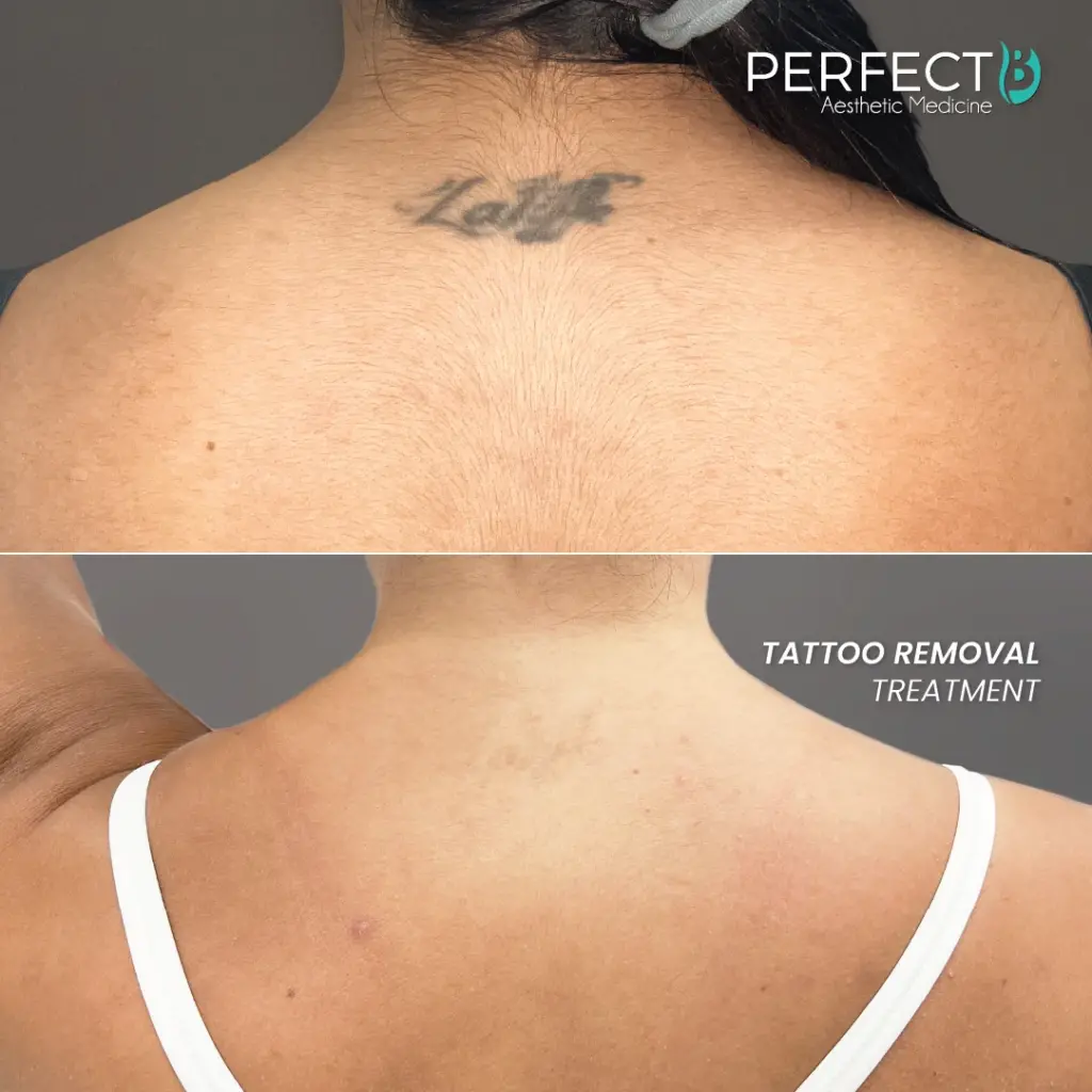 Perfect-B-Tattoo-Removal-Blog before
