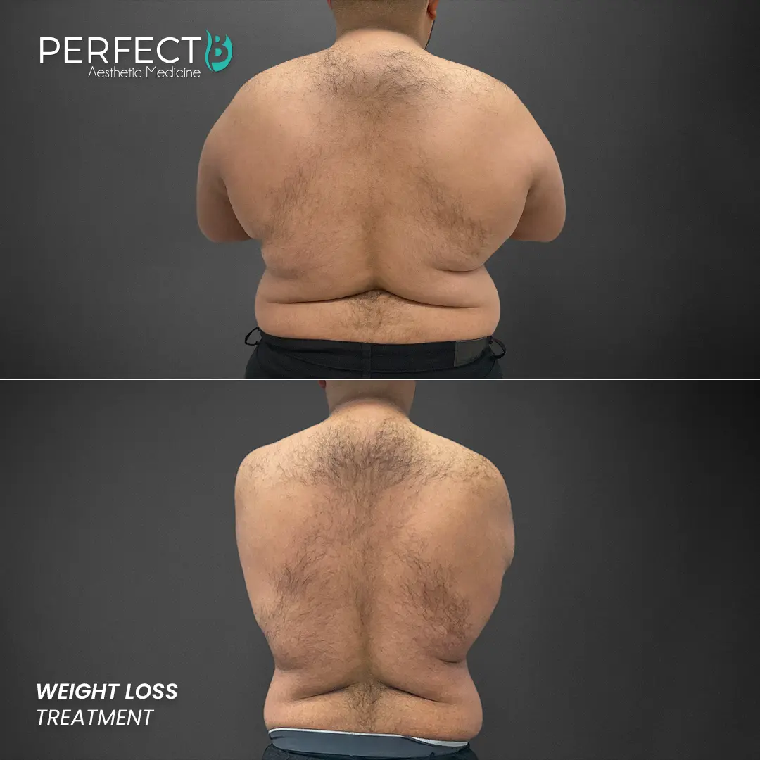 Perfect B - Results Image - [Weight Loss] 4007 - 1080 x 1080