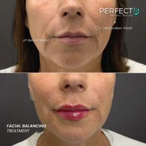 Facial Balancing Treatment - Perfect B - Results Image - Case 5801 DC - 1080 x 1080