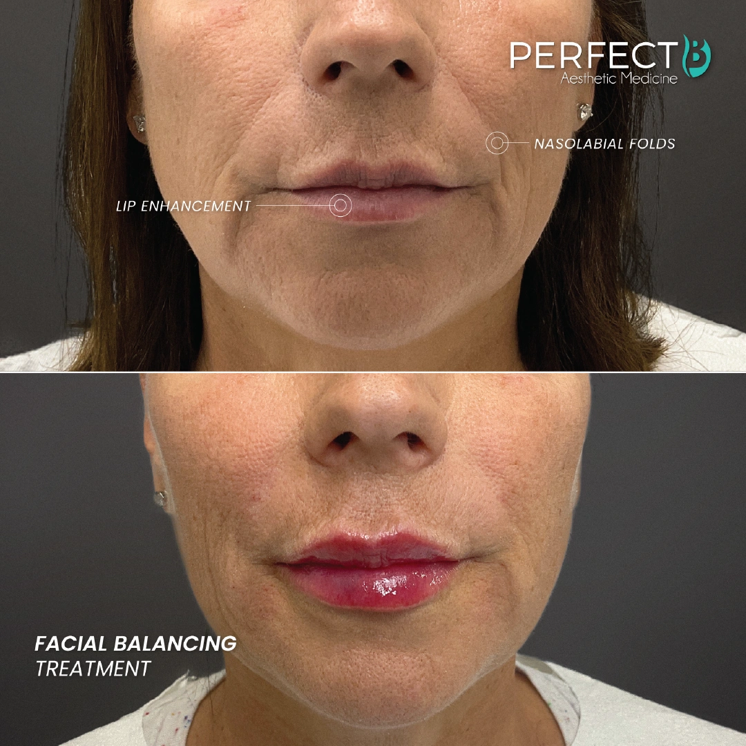 Facial Balancing Treatment - Perfect B - Results Image - Case 5801 DC - 1080 x 1080