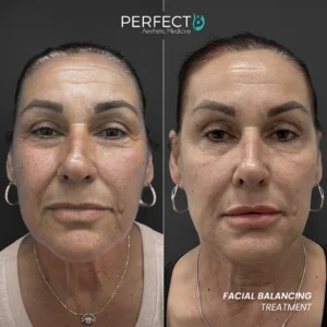 Perfect B - Results Image - [Facial Balancing] 4005 - 1080 x 1080