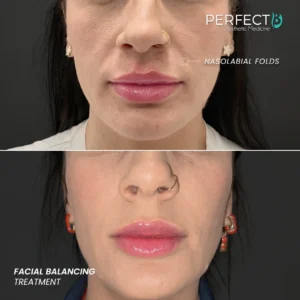 Perfect B - Results Image - [Facial Balancing] Case 4006 - 1080 x 1080