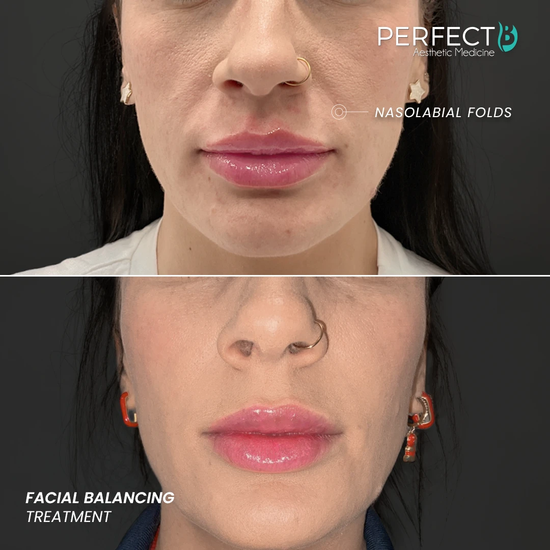 Perfect B - Results Image - [Facial Balancing] Case 4006 - 1080 x 1080