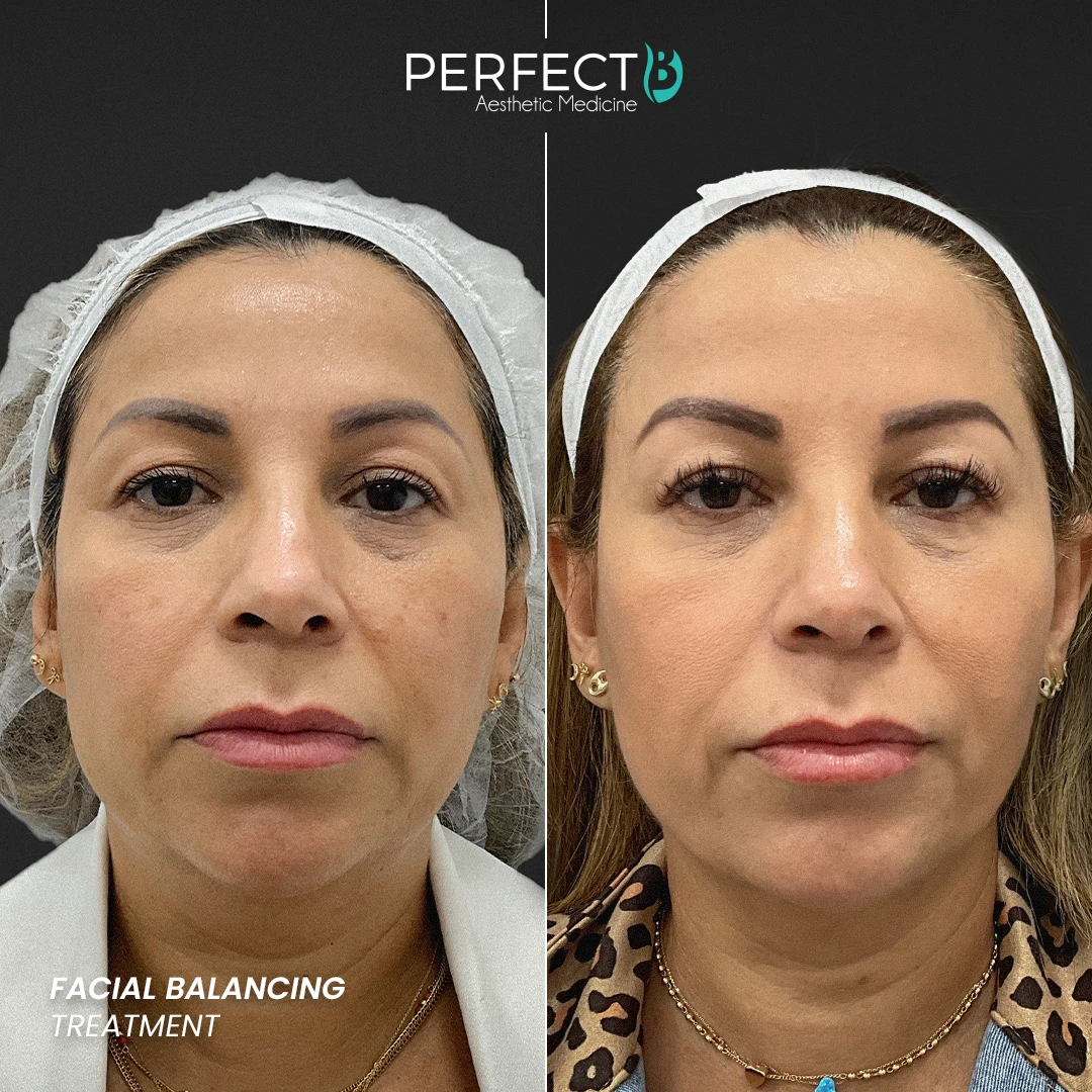 Perfect B - Results Image - [Facial Balancing] Case 4007 - 1080 x 1080