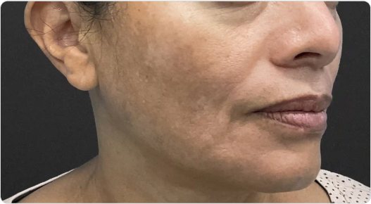 perfect b - doral_fl - skin_brightening_treatment - melasma_ case
