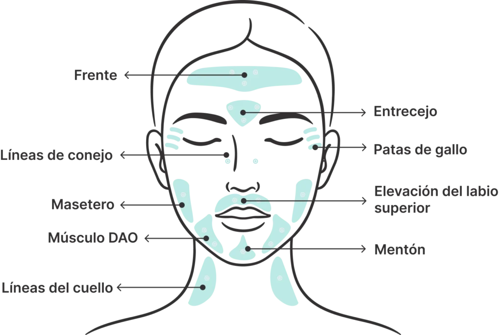 Perfect B - Neurotoxin Treatment - All areas injection illustration