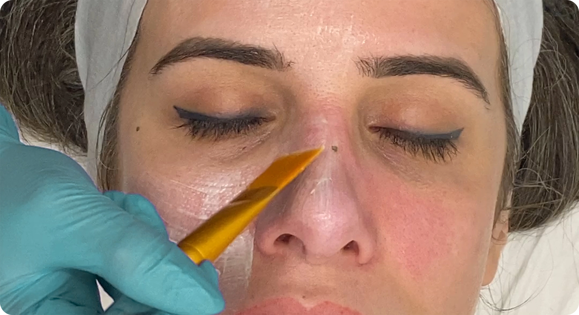 Perfect B - Blog - Chemical Peel - image2