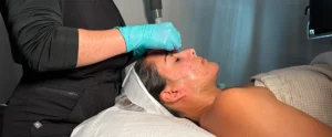 Perfect B - Blog - Chemical Peel - Hero image