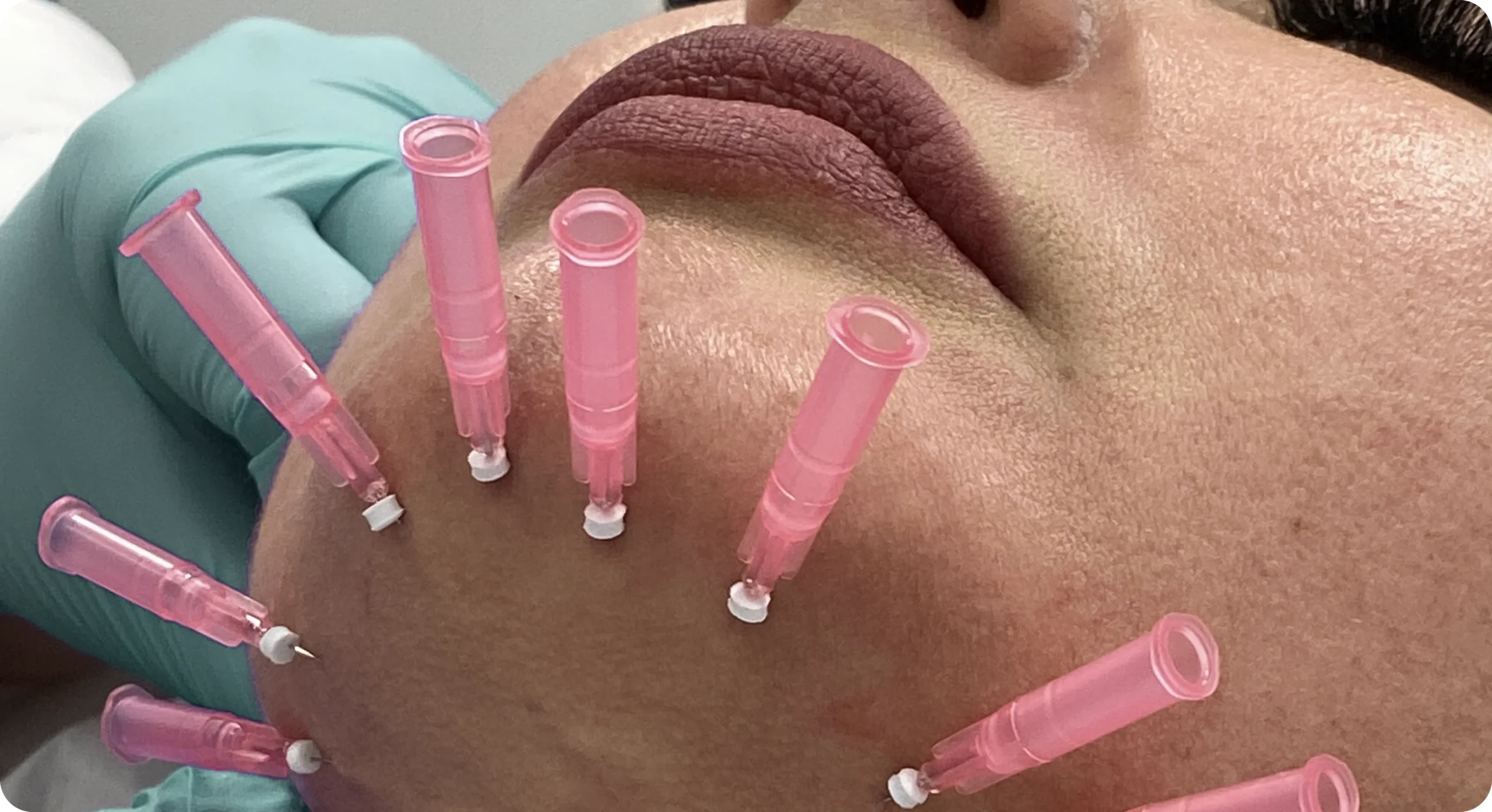 Perfect B - Blog - Face Lift Price - Image 1