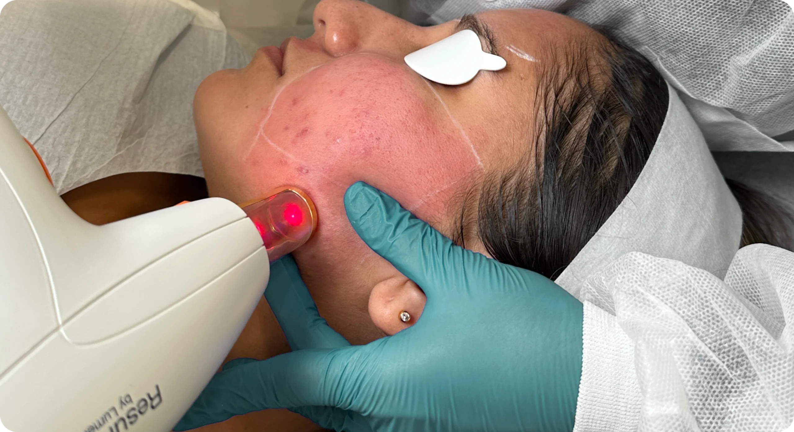 Perfect B - Blog - Laser Skin Resurfacing - Hero image 2