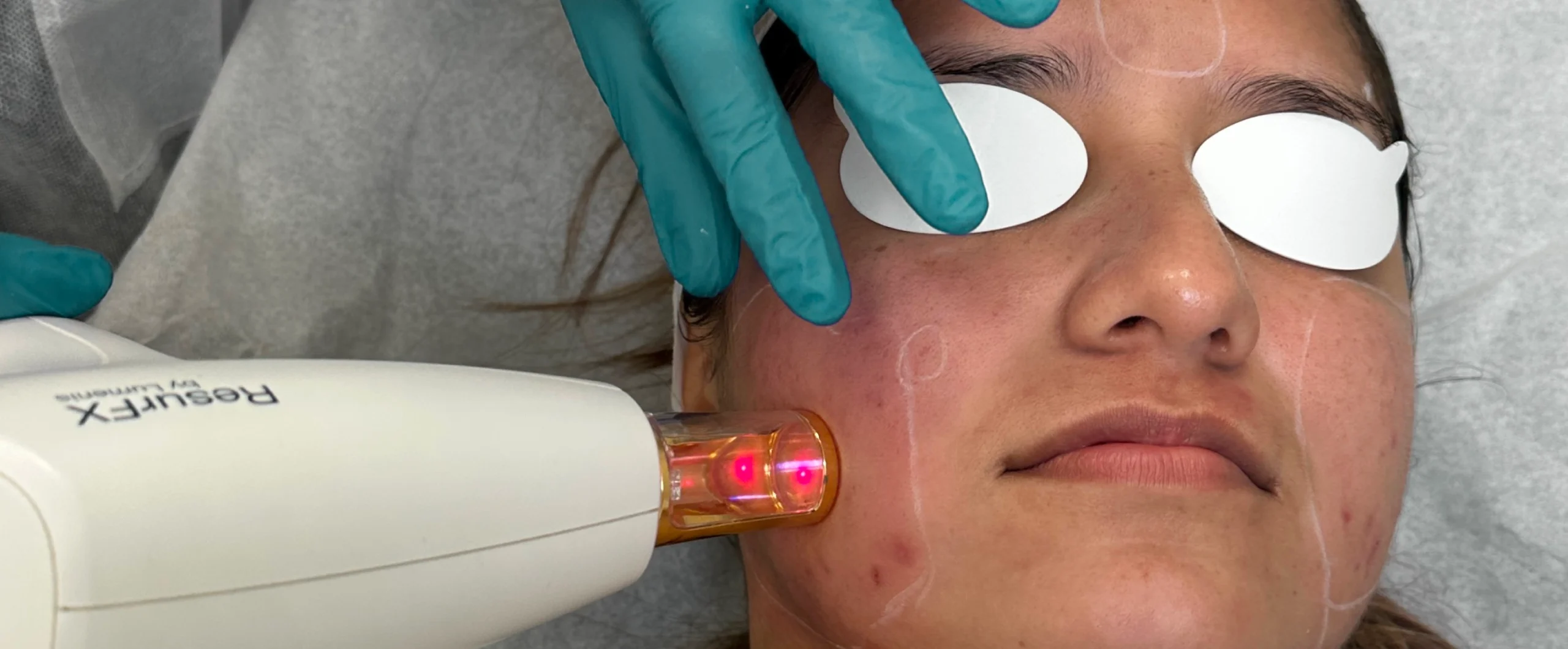 Perfect B - Blog - Laser Skin Resurfacing - Hero