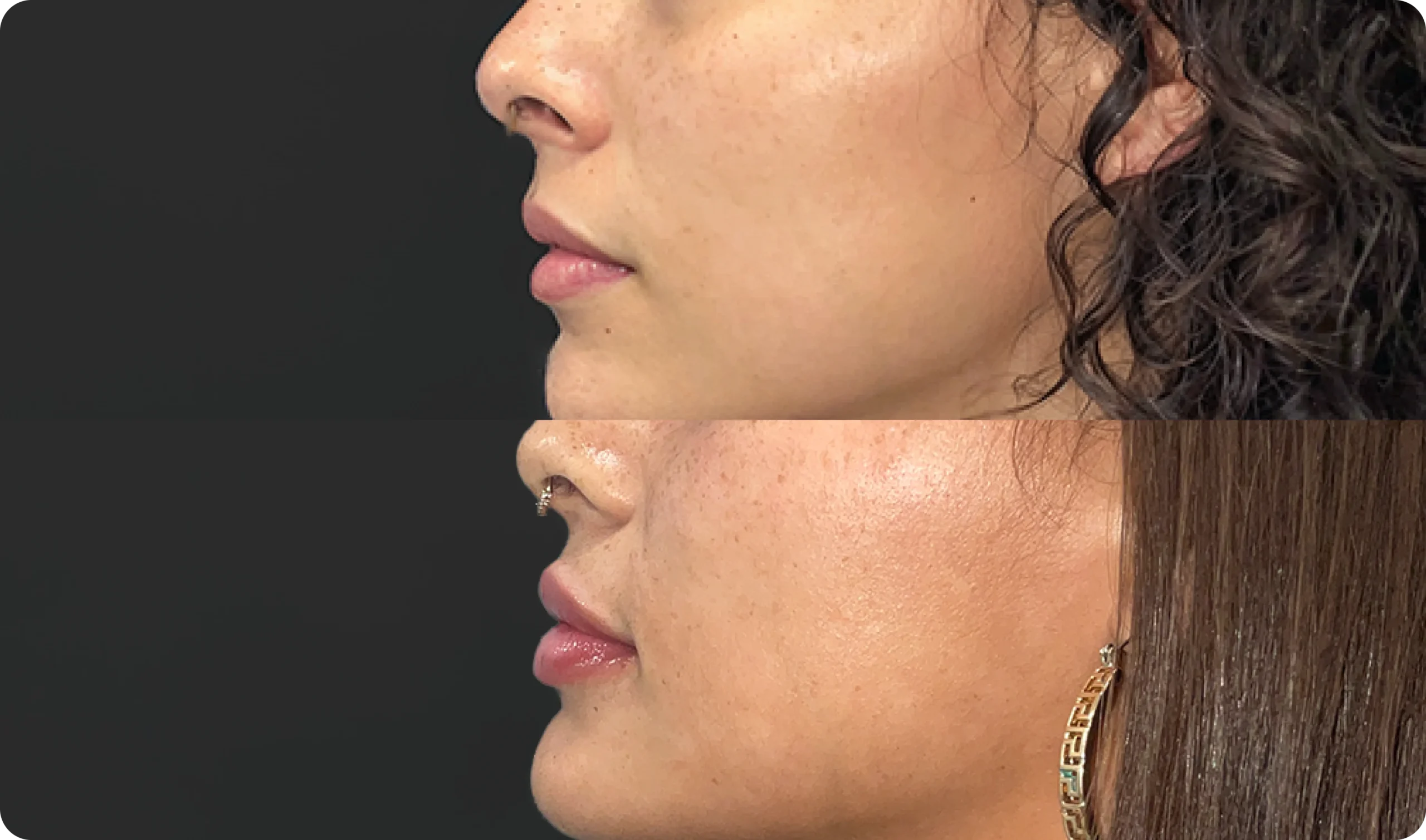 Perfect B - Blog - Lip Flip Botox_ What It Is and How Long It Lasts - Image 3