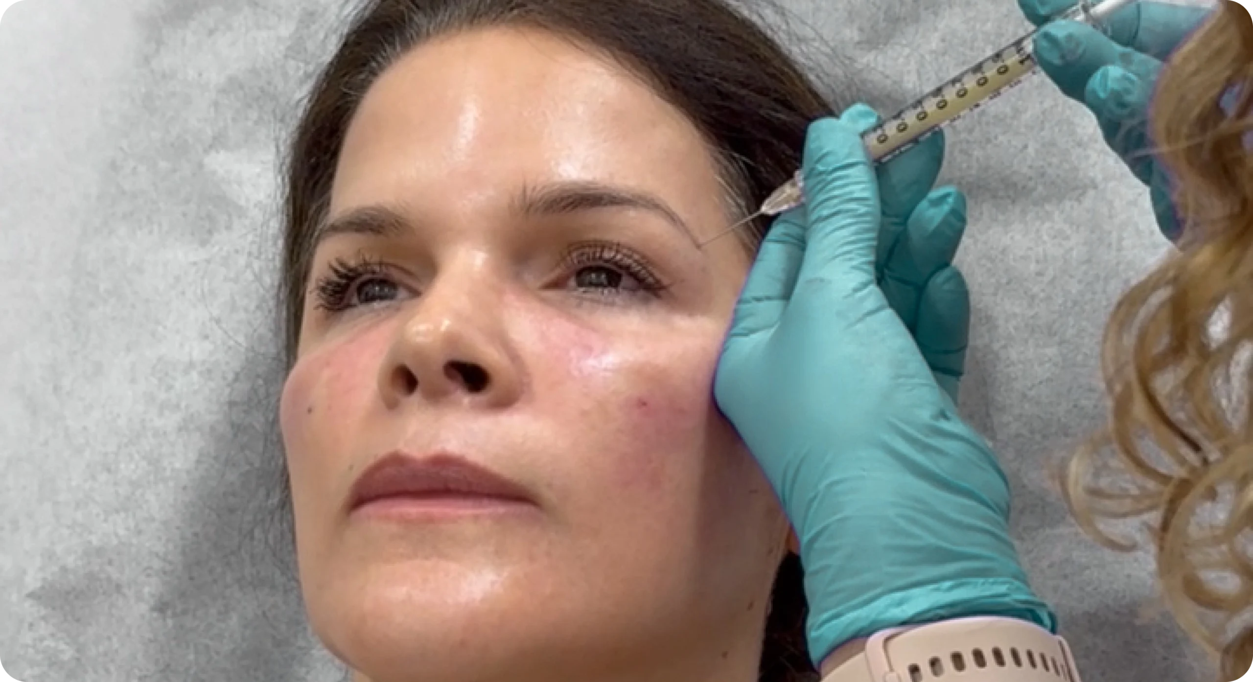 Perfect B - Blog - PRP Filler - image