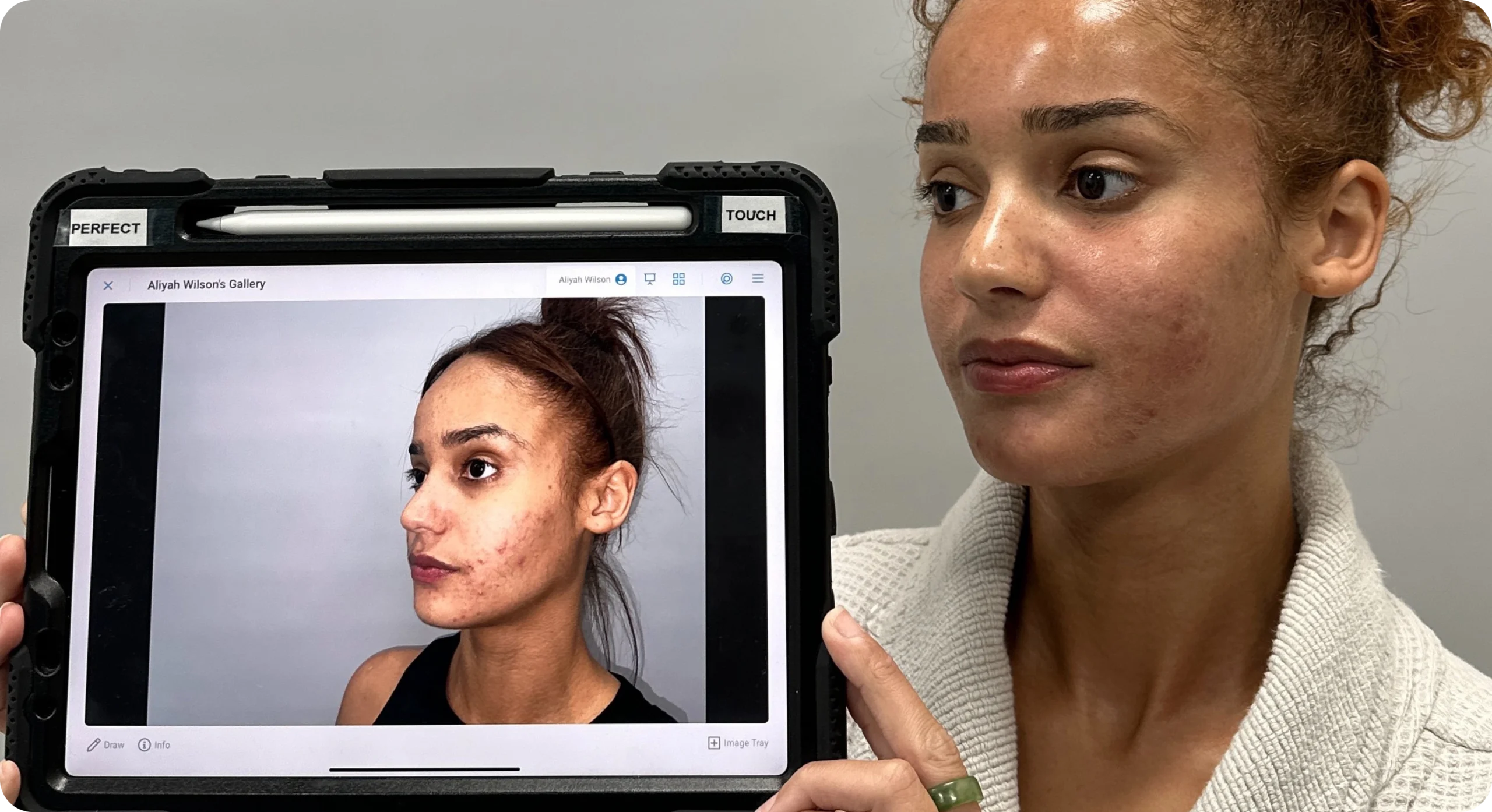 Perfect B - Blog - Acne Scar Removal - Acne patient before and after