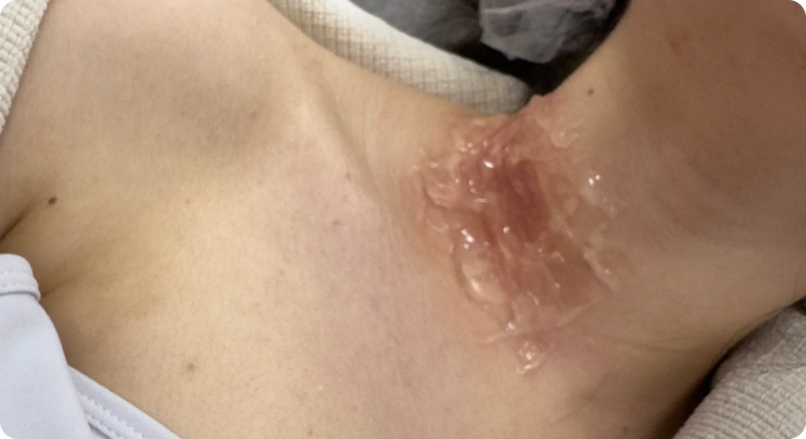 Perfect B - Blog - Tretinoin and Hydroquinone- Image 18