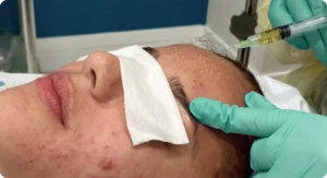 Perfect-B-Blog-Acne-Pimple-Face-Map-image-2