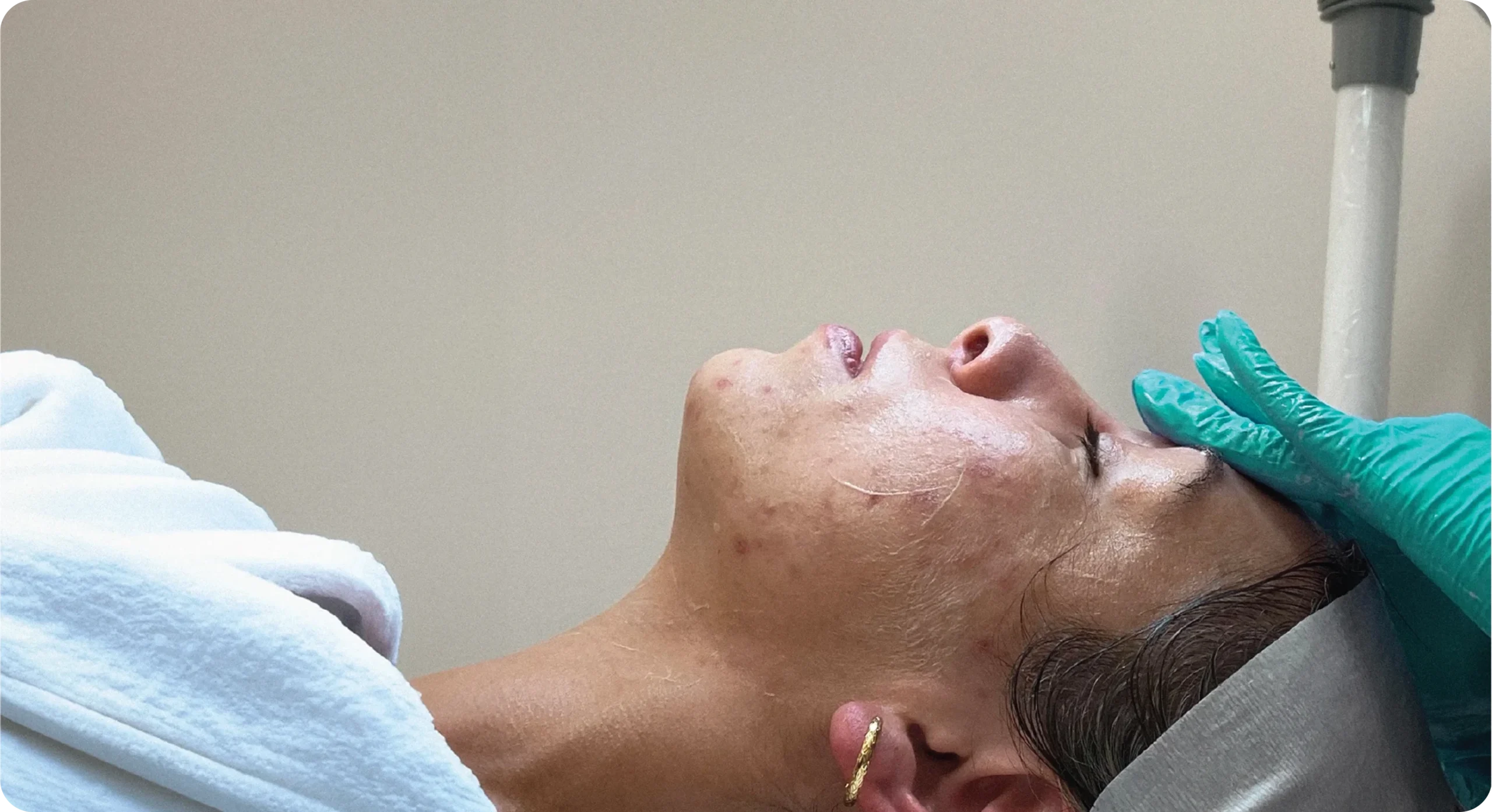 Perfect B - Blog - Tretinoin Purge Timeline What to Expect Before Your Skin Clears- Image 30