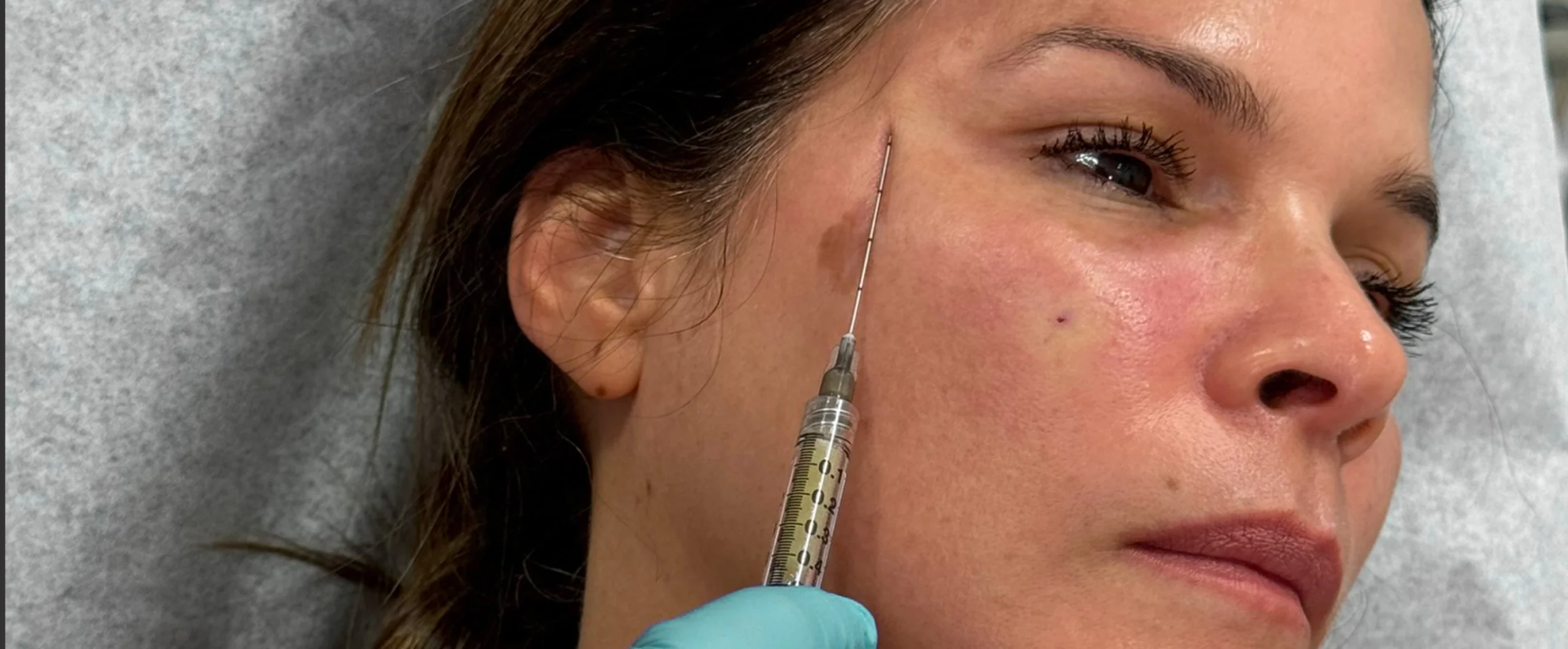 Perfect-B-Blog-PRP-Injections-PRP-Gel-Biofillers-portrait-