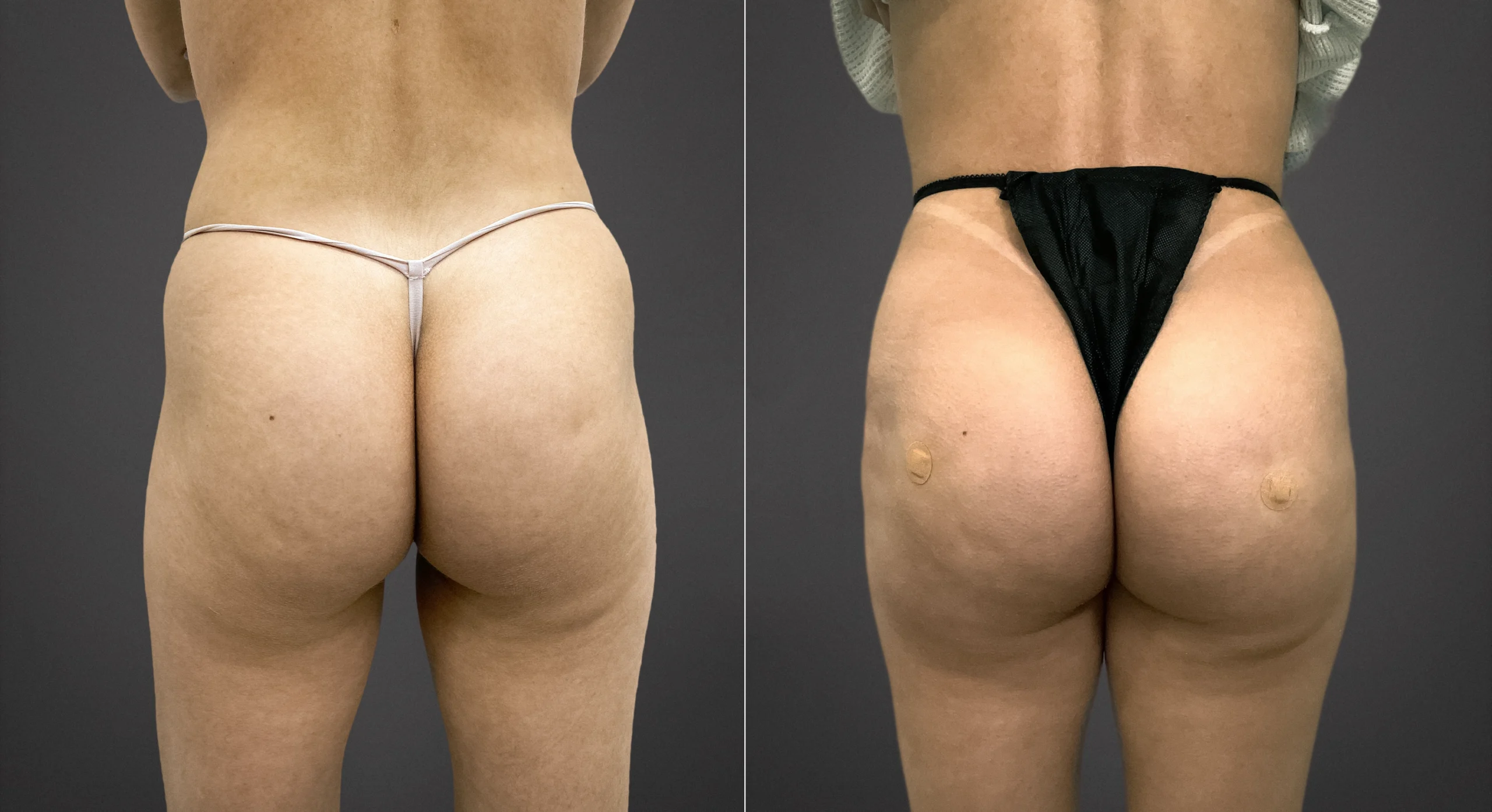 Perfect B - Bum Injection - Blog