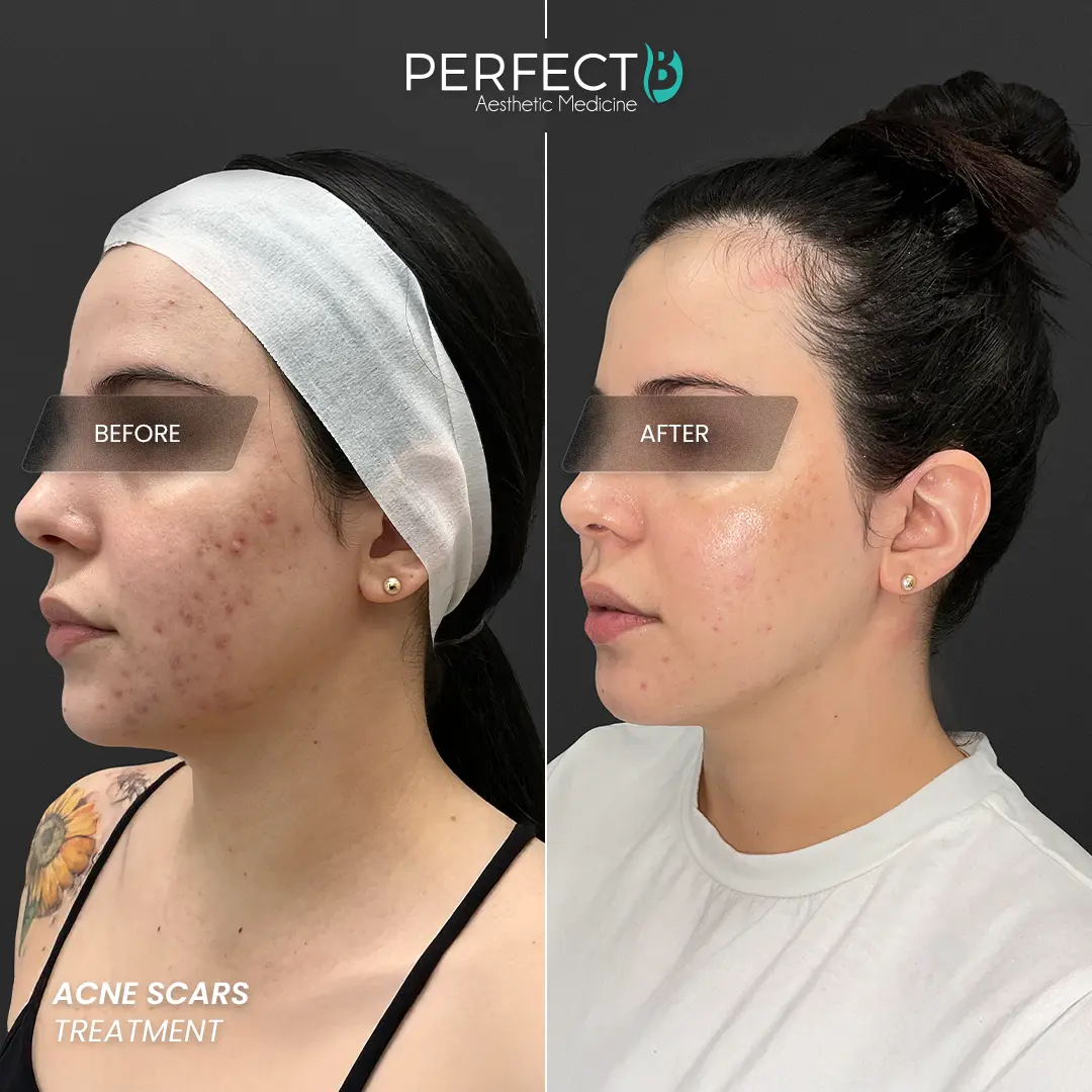 Perfect B - Results Image - [Acne Scars] 4002 - 1080 x 1080