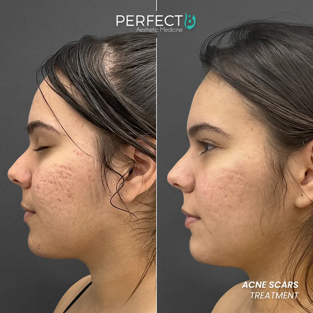 Perfect B - Results Image - [Acne Scars] 4009 - 1080 x 1080