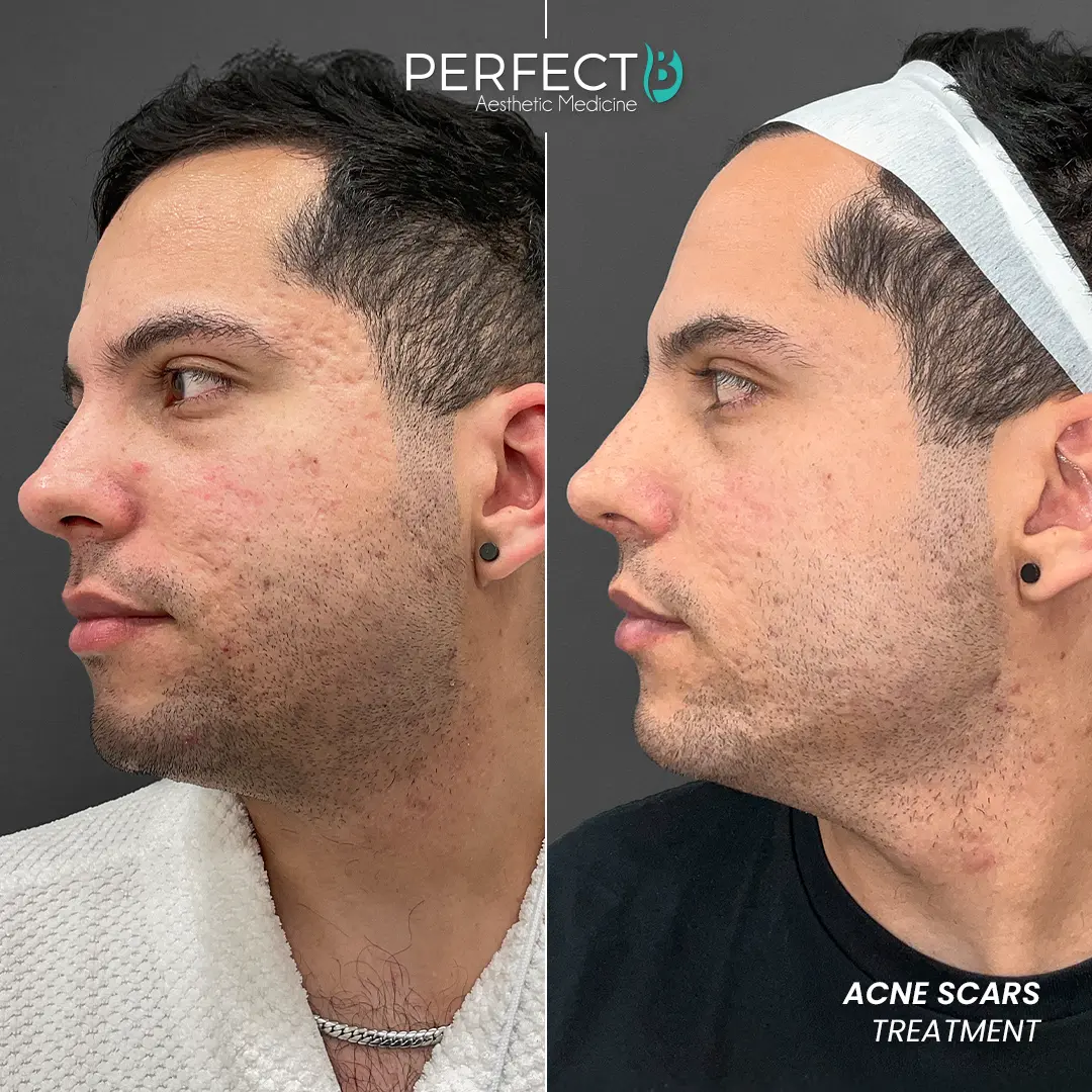 Perfect B - Results Image - [Acne Scars] 4010 - 1080 x 1080