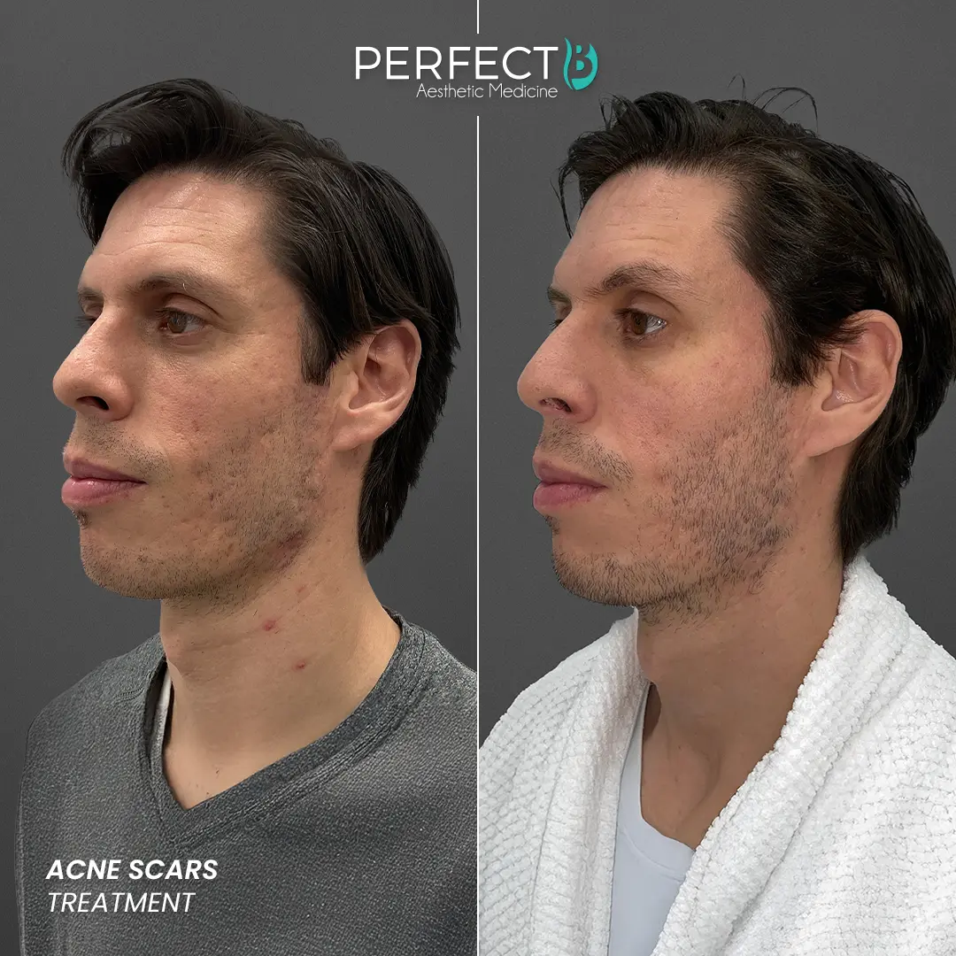 Perfect B - Results Image - [Acne Treatment] 4001 - 1080 x 1080
